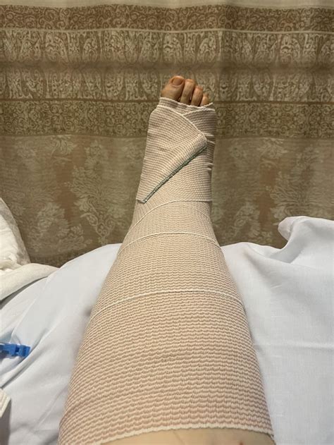 Surgery done! : r/PTTD