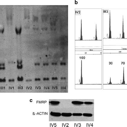 Pdf Four Sisters Compound Heterozygotes For The Pre And Full