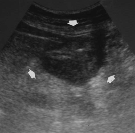 Gastroesophageal Junction Ultrasound