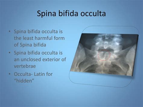 Ppt Spina Bifida Latin Split Spine Powerpoint Presentation Free