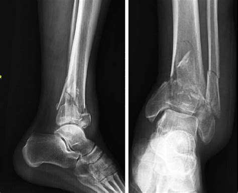 Pilon Fracture Before Treatments By Ap X Ray Indicating Tibia And