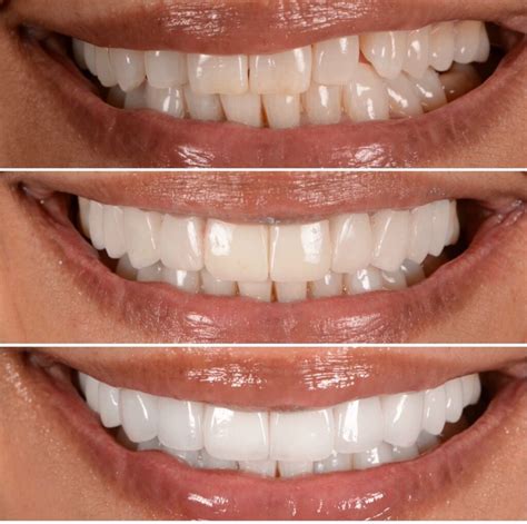 Dental Veneers How Do They Work Bespoke Smile