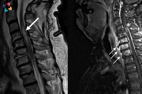 Understanding Transverse Myelitis Symptoms Causes Diagnosis And