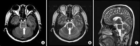 Brain magnetic resonance imaging (MRI) scan at the level of the pons:... | Download Scientific ...