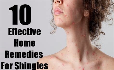 10 Home remedies for Shingles - Morelia Medical Clinic