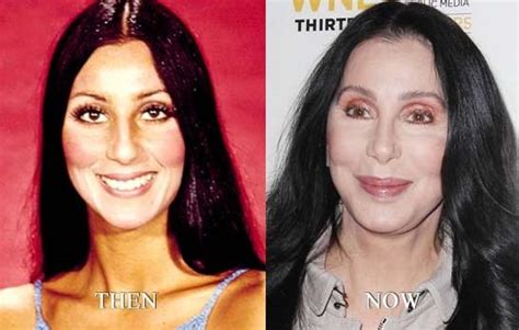 Cher before and after plastic surgery 05 – Celebrity plastic surgery online