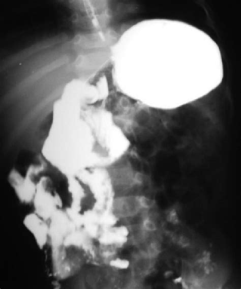 Image:Malrotation of the Bowel-MSD Manual Professional Edition