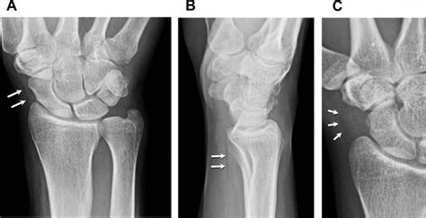 Normal Scaphoid X Ray