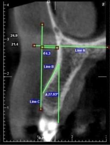 Figure 1 From Evaluation Of The Concavity Depth And Inclination In Jaws