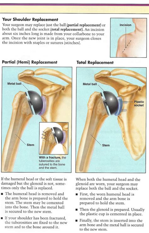 Dr John Skedros Shoulder Procedures