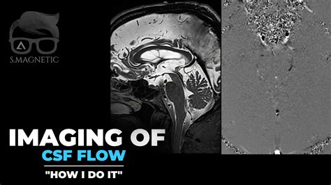 Imaging of csf flow. MRI. Tune in and check it out. Link in comment ...