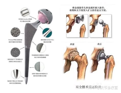 人工髋关节置换 知乎