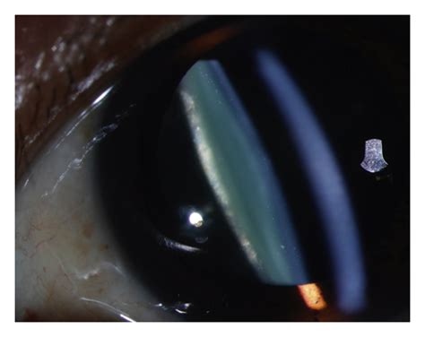 Posterior Subcapsular Cataract