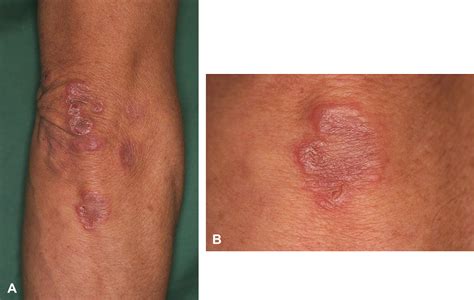 Granuloma Annulare Like Skin Lesions As An Initial Manifestation In A