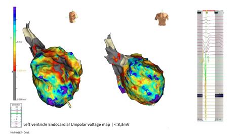 Endocardial And Epicardial Ventricular Tachycardia Substrate D Mapping