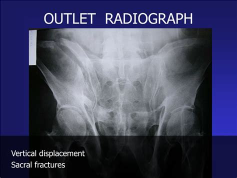 Ppt Pelvis And Acetabulum Fractures Powerpoint Presentation Free