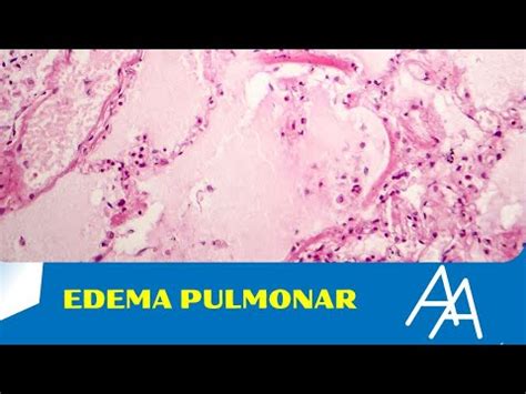 Edema Pulmonar Causas Síntomas Y Tratamiento Doctor Online