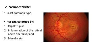 optic neuritis pptx
