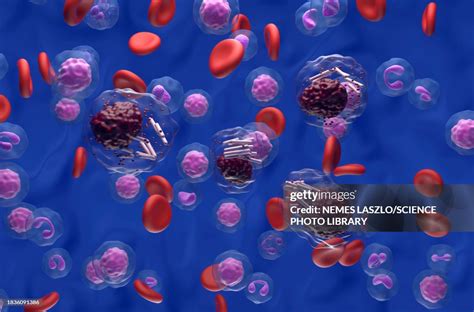 Auer Rods In Acute Promyelocytic Leukaemia Illustration High-Res Vector ...