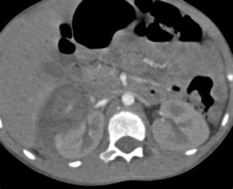 Right Renal Laceration with Multiple Phases. Delayed Phase Nicely Shows the Extravasation from ...