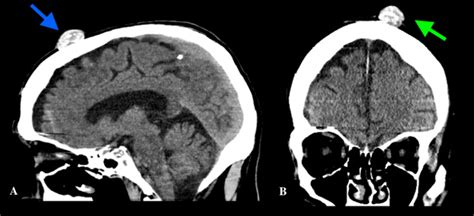 trichilemmal cyst radiology articlnet