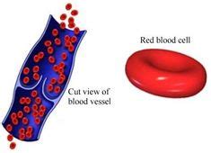 Pernicious Anemia