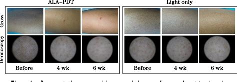 Figure From Comparison Of Aminolevulinic Acid Photodynamic Therapy