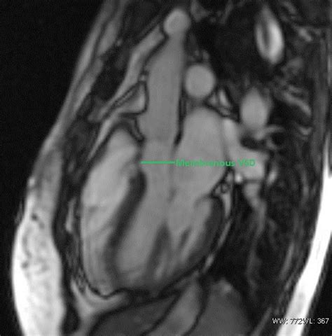 Ventricular Septal Defect Cardiac Mri