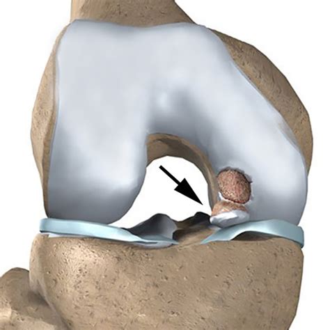 Osteochondritis Dissecans - Assoc. Dr. Murat Kaya