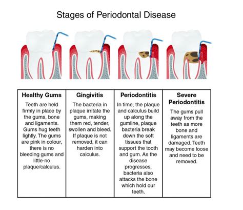 Gum Disease Progression Hot Sex Picture