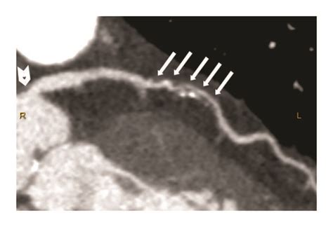 Computed Tomography Coronary Angiography CTCA Showing Three Vessel