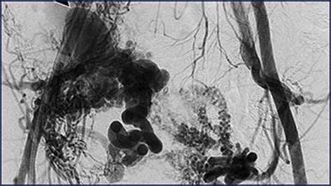 Arteriovenous Malformation Associated With Intravenous Leiomyomatosis