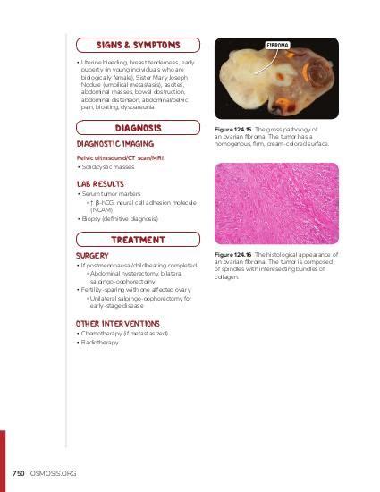 Choriocarcinoma Gross Image