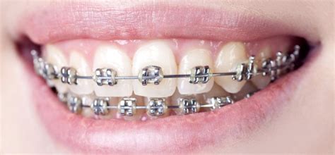 Braces- Silver