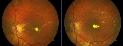 Edema Macular Diabético FotomodulaciÓn LÁser Amarillo