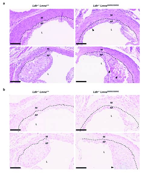 Presence Of Erythrocytes And Iron Deposits In Atheromas Of Fat Fed Male