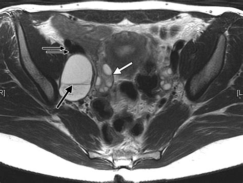 Nonovarian Cystic Lesions Of The Pelvis Radiographics