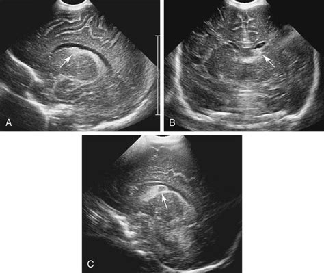 Germinal Matrix Hemorrhage Grade 1