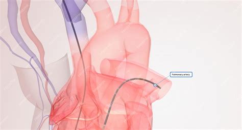 Premium Photo | Right heart catheterization involves a catheter that is passed through a vein ...