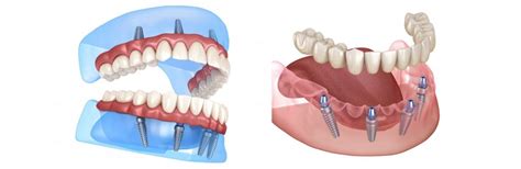 The Dental Implants Procedure and What You Need to Know | Advanced ...