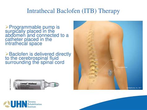 Ppt Spasticity And The Use Of The Baclofen Pump For The Sci Patient