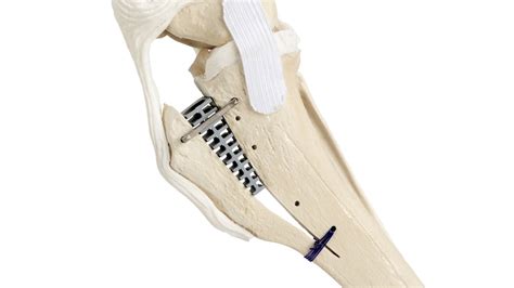 Tta 2 Tibial Tuberosity Advancement Kyon