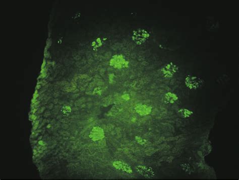 Immunfluorescence Microscopy Showed Mesangial Staining For IgA FITC