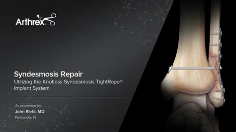 Arthrex Syndesmosis Repair Utilizing The Knotless Syndesmosis