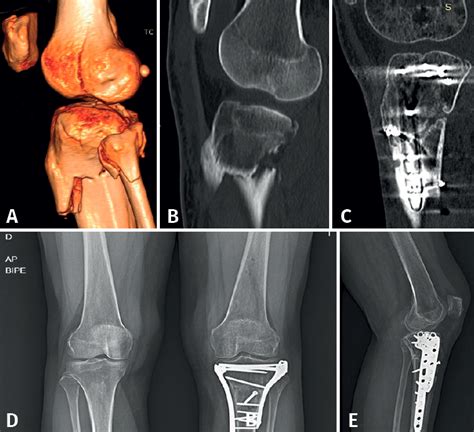 Manejo De Las Fracturas Osteocondrales De La Rodilla Fondoscience