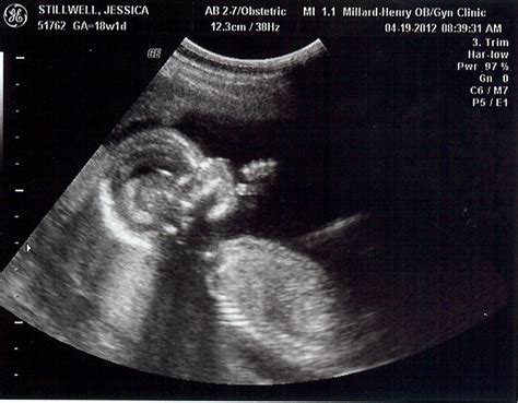 Making More Than Memories...: 18 Weeks & Ultrasound