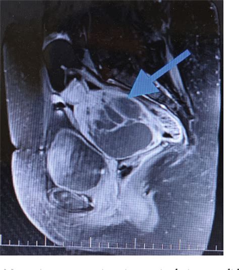 Figure From Ileal Schwannoma A Rare Cause Of Pelvic Mass Semantic