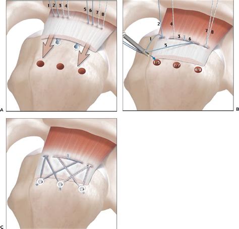 Rotator Cuff Tear Anchors