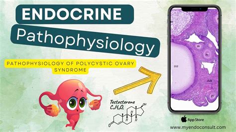 Pathophysiology Of Polycystic Ovary Syndrome My Endo Consult