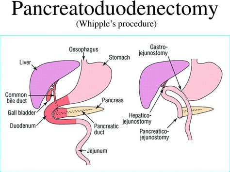 Ppt Adenocarcinoma Of The Pancreas Powerpoint Presentation Id2174291